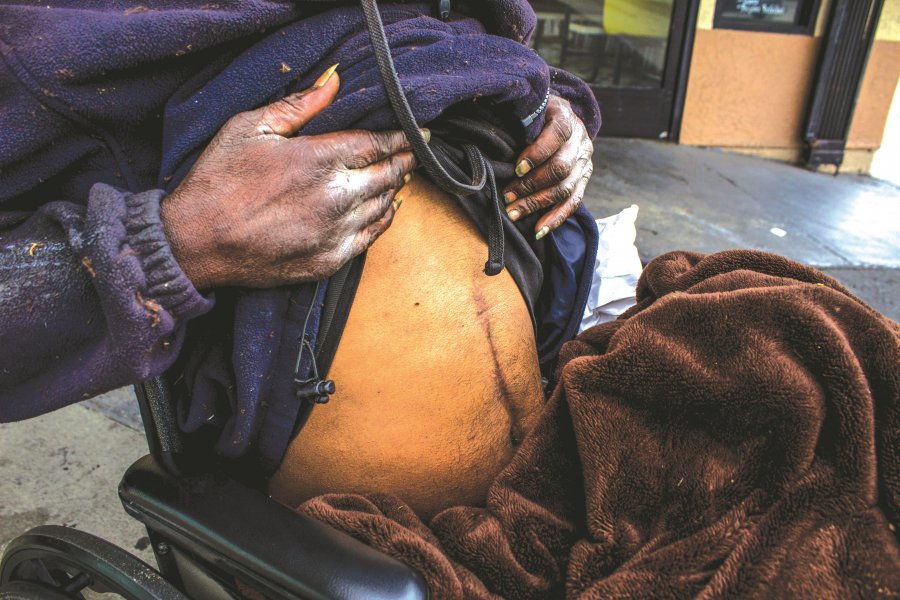 A man lifts his shirt to reveal a scar across his abdomen.